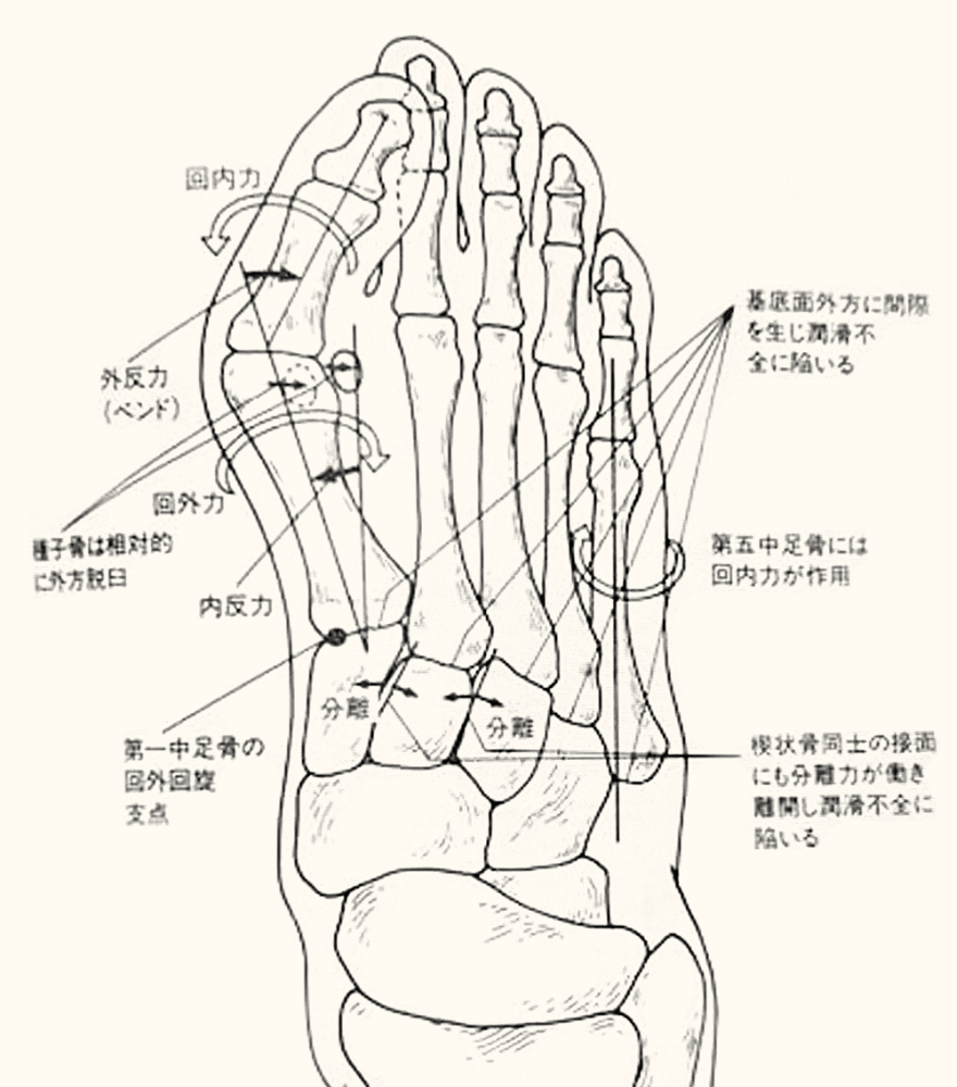 外反母趾図